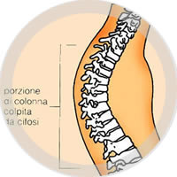 patologie curate ipercifosi