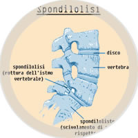  studio fisioterapico scanavino roberi torino   spondilolisi