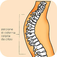 posturatorino patologia ipercifosi