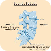 posturatorino spondilolisi
